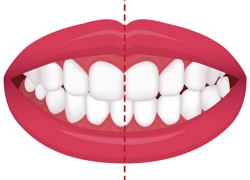 example of a cross bite common orthodontic issue