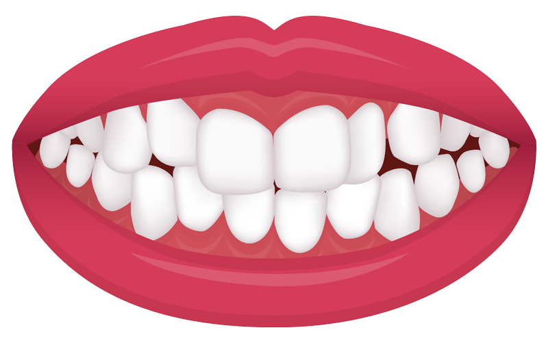 example of a crowding bite common orthodontic issue