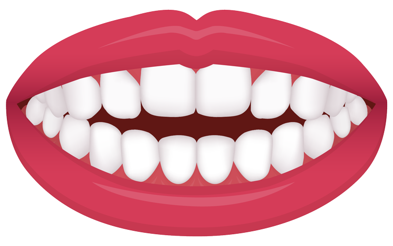 example of an open bite common orthodontic issue