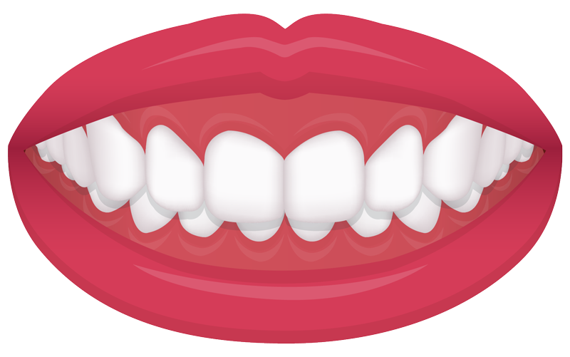 example of an over bite common orthodontic issue