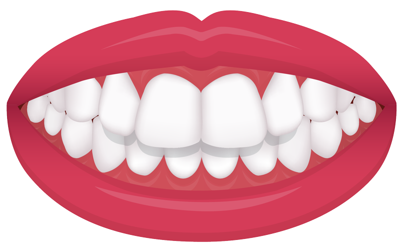 example of a protrusion bite common orthodontic issue