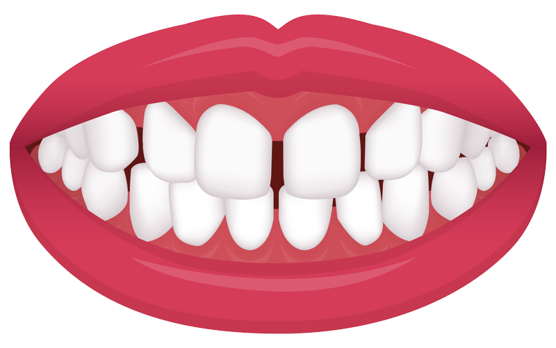 example of an spacing common orthodontic issue