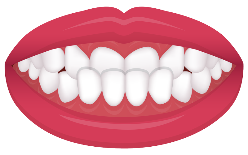 example of an under bite common orthodontic issue