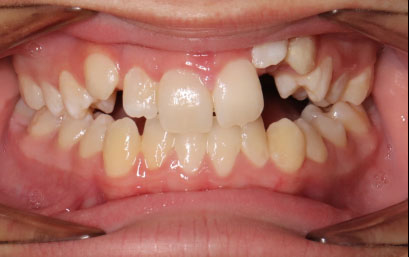 Logun-before