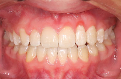 logun-after